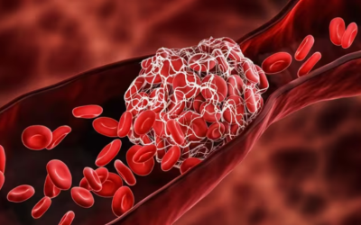 ALIPANC researchers conducted a study that links venous thromboembolic disease (VTE) with poorer survival in pancreatic cancer patients